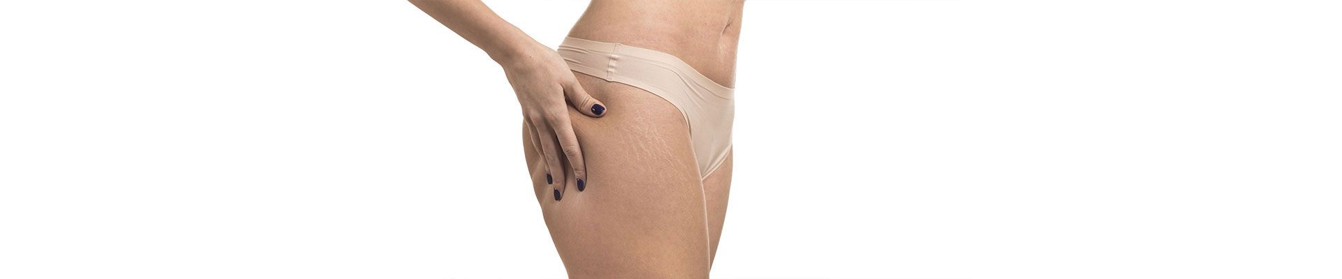 Wie kann man Dehnungsstreifen reduzieren?