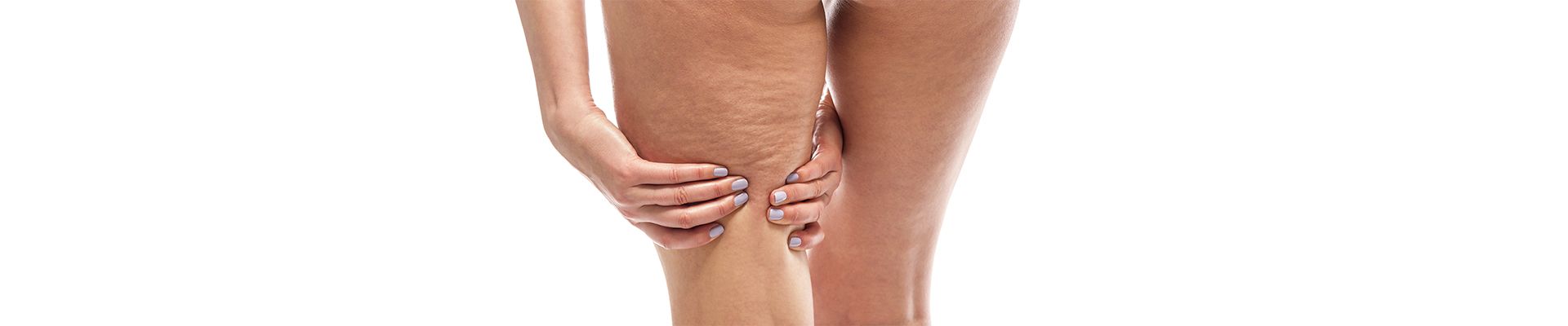La cellulite, la hantise de toutes les femmes !