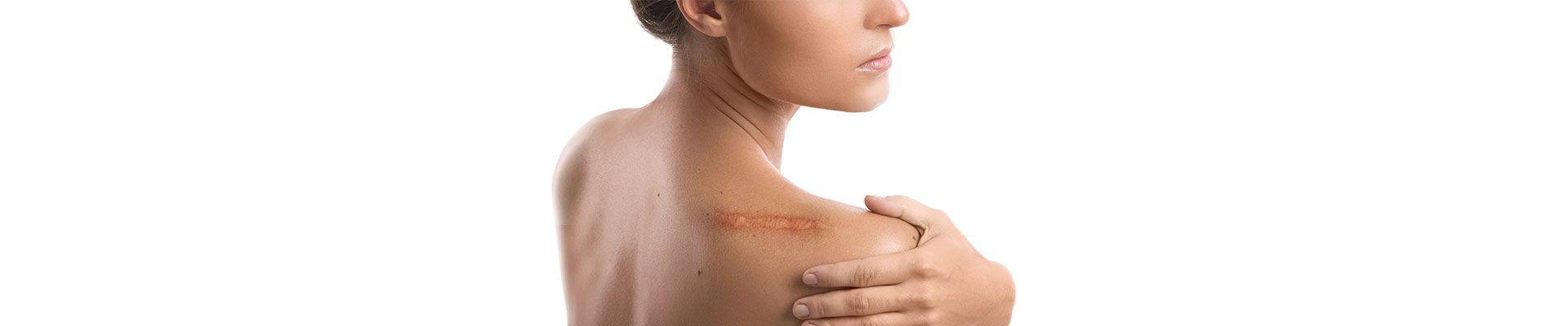 Narben vermindern: unsere Tipps