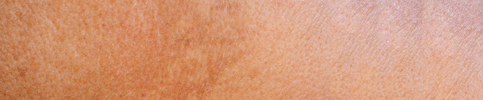 Was ist eine Hyperpigmentierung?