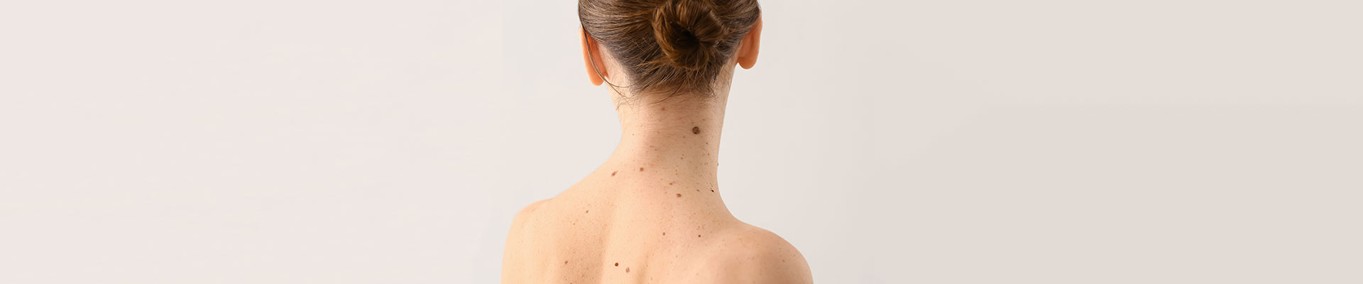 Muttermale, warum sollte man seine Haut beobachten?