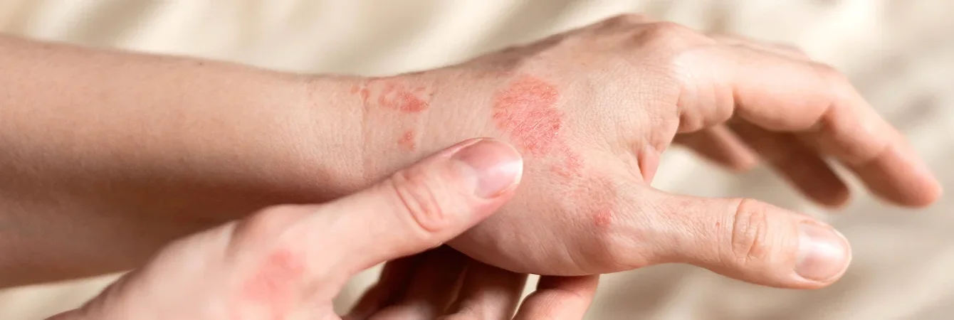 Irritationen und Ekzem: Ursachen erkennen und passende Pflegeprodukte wählen