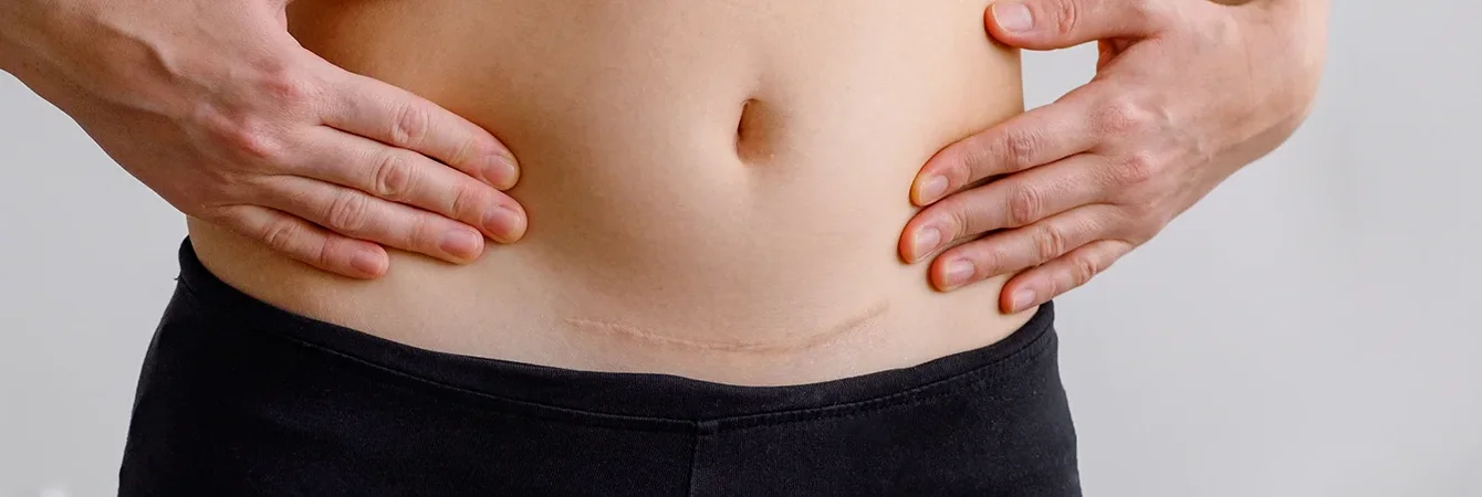 Warum bleiben manche Narben bestehen?