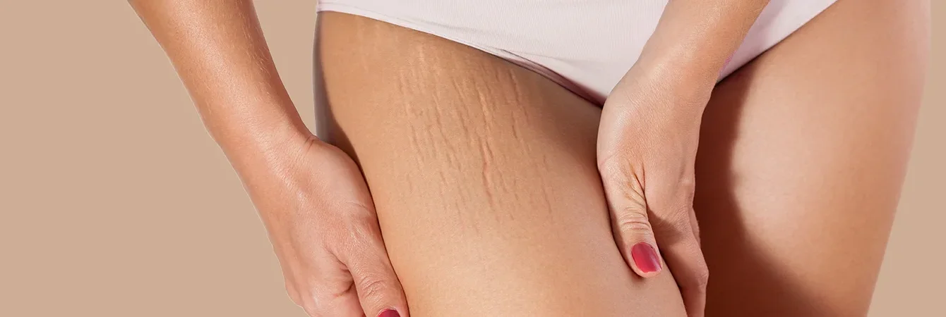 Dehnungsstreifen und Hauterschlaffung: die Rolle von Bindegewebe und Ernährung verstehen