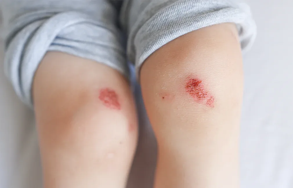 Quand la peau souffre en été : comment réparer et apaiser les petites blessures ?